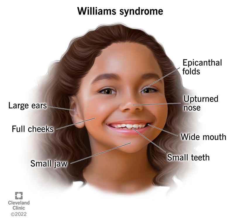 15174 williams syndrome