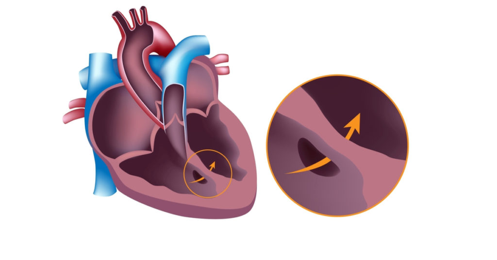 تُعتبر مشكلة ثقب القلب عند الاطفال حديثي الولادة من أشهر أمراض القلب التي تصيب الأطفال، وتحدث نتيجة عيب خلقي في مرحلة تكون قلب الطفل في رحم الأم.